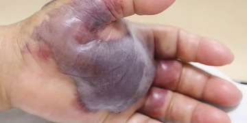 BAKTERIA Vibrio vulnificus dilapor memusnahkan tisu kulit sehingga menjadi hitam dan mati. – AGENSI