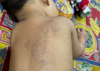 KEADAAN badan anak lelaki Syaza Syamimi yang terdapat kesan lebam yang berkemungkinan dipukul atau jatuh pada objek keras.