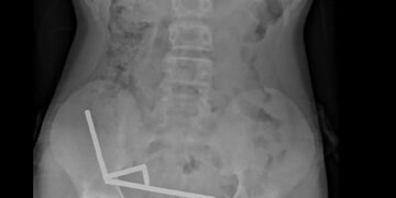 IMEJ sinar-X menunjukkan ketulan magnet berkuasa tinggi yang terkumpul dalam usus seorang remaja di Tauranga, New Zealand.-AFP