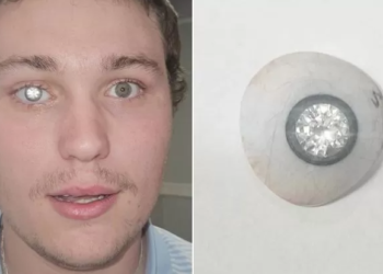 SLATER John menukar mata butanya dengan mata palsu bertatahkan berlian dua karat. – AGENSI