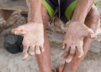 PENYAKIT kusta muncul semula di Eropah selepas kes baharu dikesan di Romania dan Croatia.-AGENSI