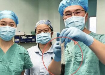 DOKTOR menunjukkan pemetik api yang dikeluarkan dari perut seorang lelaki di Chengdu, China. - AGENSI