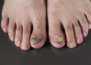 JANGKITAN kulat pada kuku kaki lebih lambat pulih berbanding kuku tangan.