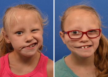 KEADAAN wajah seorang kanak-kanak akibat Bell’s palsy (kiri) dan selepas mendapatkan rawatan.