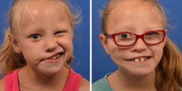 KEADAAN wajah seorang kanak-kanak akibat Bell’s palsy (kiri) dan selepas mendapatkan rawatan.