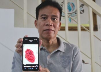 HELMI Gimmick menunjukkan buah pinggang belah kirinya seberat lima kilogram yang berjaya dibuang menerusi pembedahan pada 8 Januari lalu selepas disahkan menghidap kanser tahap empat pada September tahun lalu ketika ditemui di kediamannya di Bandar Baru Nilai, Seremban, semalam.- UTUSAN/NOR SHAFIQAH MOHD. GHAZALI