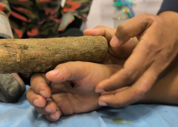 KEADAAN tangan mangsa ditembusi paku yang melekat pada sebatang kayu semasa bermain di sebuah rumah dusun di Kuala Krai, Kelantan semalam.-IHSAN BOMBA
