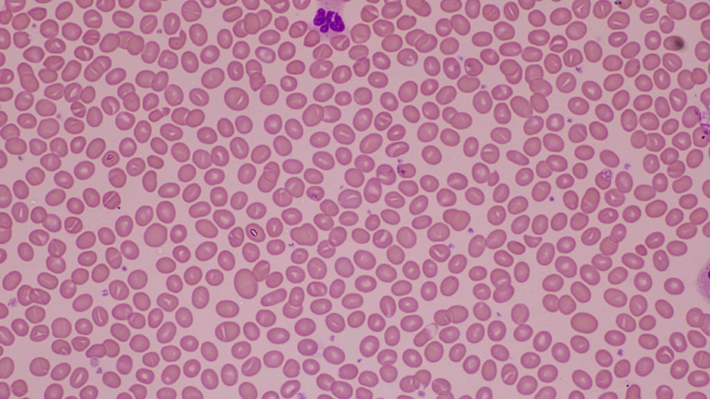 Southeast Asian Ovalocytosis: Understanding the genetic trait