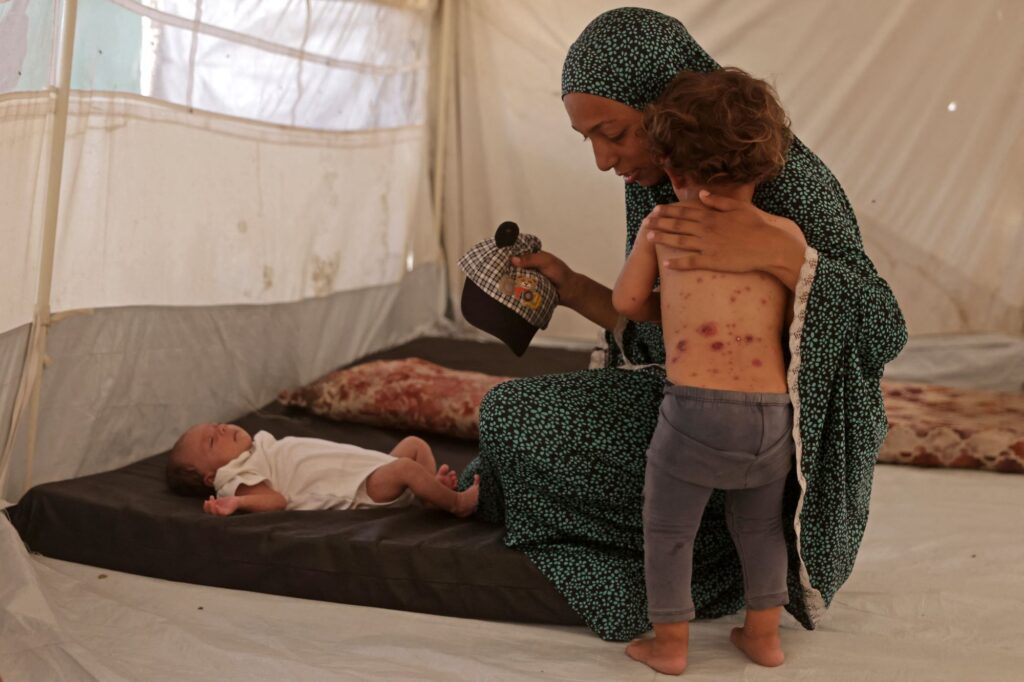 Chickenpox Spreads Through Crowded Gaza Refugee Camps
