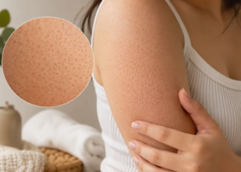 KERATOSIS pilaris berlaku apabila keratin daripada sel kulit mati menyumbat folikel rambut, menyebabkan kulit kasar dan berbintik seperti kulit ayam.