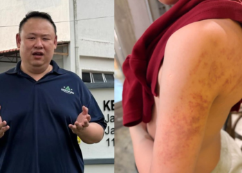 ANDREW OOI (kiri) dan gambar menunjukkan kesan kecederaan yang dialami oleh seorang murid di sekolah terbabit.