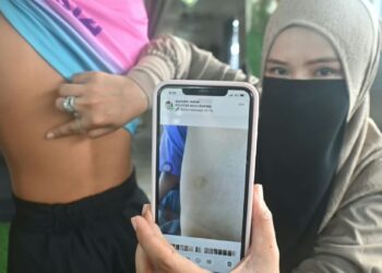 SITI Rohani Yusof menunjukkan bahagian badan anaknya yang lebam akibat dibuli di asrama sebuah sekolah menengah agama di Bukit Ibam di Rompin, Pahang. – MINGGUAN/SHAIKH AHMAD RAZIF