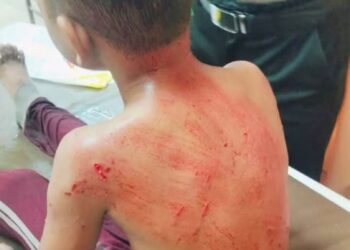 KEADAAN Azuar Firdaus Zuraiman yang cedera di gigit anjing liar di Pantai Kuala Kemasin, Bachok, Kelantan.