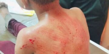 KEADAAN Azuar Firdaus Zuraiman yang cedera di gigit anjing liar di Pantai Kuala Kemasin, Bachok, Kelantan.