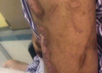 KEADAAN tangan Bella yang penuh dengan parut dan kesan melecur akibat penderaan .