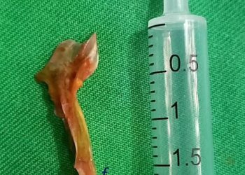 TULANG ikan yang dikeluarkan dari usus lelaki tersebut. - AGENSI