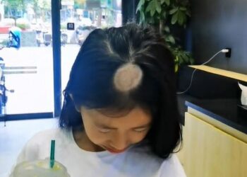 KANAK-KANAK perempuan mengalami keguguran rambut selepas seminggu membela kucing peliharaan. - ASIAWIRE