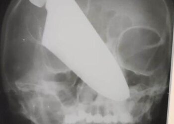 IMEJ x-ray menunjukkan pisau tertusuk pada hidung wanita itu. - MOH KRASNODAR KRAI