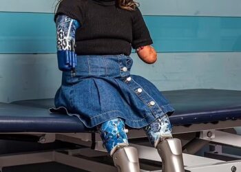 HARMONIE Rose Allen gembira menggunakan kaki palsu pintar baharunya.-AGENSI