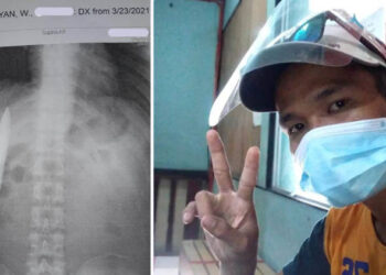 IMBASAN x-ray Kent Ryan Tomao menunjukkan mata pisau sepanjang empat inci tersangkut dalam dadanya. - AGENSI