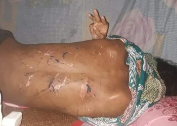BELAKANG badan mangsa lelaki dipenuhi calar balar akibat dipukul dengan kabel wayar selepas dibebaskan junta tentera. -CNN