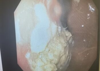 IMBASAN menunjukkan jisim pepejal besar tersekat di perut kanak-kanak itu. - AGENSI