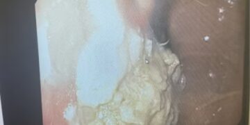 IMBASAN menunjukkan jisim pepejal besar tersekat di perut kanak-kanak itu. - AGENSI