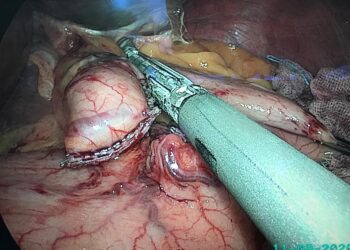 Pembedahan buang usus ada syarat khusus bagi mengelakkan risiko bahaya lain termasuk kematian. - Gambar hiasan