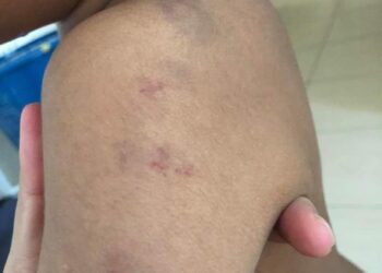 Sseorang budak istimewa berusia enam tahun mempunyai kesan lebam disyaki akibat didera ketika dihantar ke sebuah pusat terapi di Skudai, Johor.