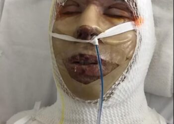 BRODIE McDougal cedera parah selepas dibakar hidup-hidup oleh seorang lelaki dalam satu kejadian di  Perth, Australia. - AGENSI