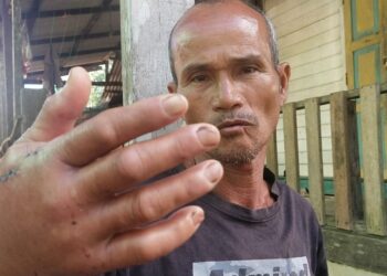 CHE Man Zakaria menunjukkan tangan kanannya yang cedera akibat digigit seekor anak buaya di kawasan paya di Padang Papan, Manir, Kuala Terengganu, Jumaat lalu. - UTUSAN/TENGKU DANISH BAHRI TENGKU YUSOFF