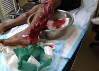 KECEDERAAN kaki dialami mangsa akibat dibaham buaya-IHSAN MEDIA SOSIAL