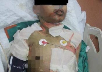 SEORANG pemuda yang membakar diri di sebuah stesen minyak di Muar kini dirawat di Hospital Segamat.