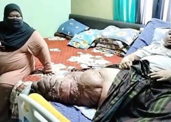 SHAHRUL Anuar Halimi menunjukkan kaki kanannya yang membengkak dan membesar sehingga 100kg di rumahnya di Kampung Buaia, Padang Rengas. - UTUSAN