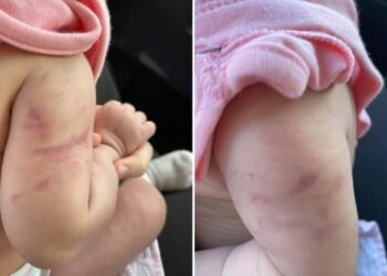 GAMBAR tular dalam media sosial menunjukkan kesan pada lengan seorang bayi perempuan berusia lima bulan dipercayai didera pengasuh di Shah Alam, Selangor.