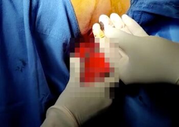 DOKTOR berjaya mengeluarkan peluru itu daripada badan Nemi Chand. - AGENSI