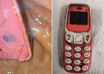 GAMBAR telefon bimbit Nokia 3310 yang ditelan oleh lelaki tersebut. - SKENDER TELAKU