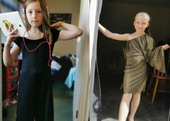 KEADAAN Amelia Mansie sebelum dan selepas mencabut rambutnya sendiri. - DAILY MAIL