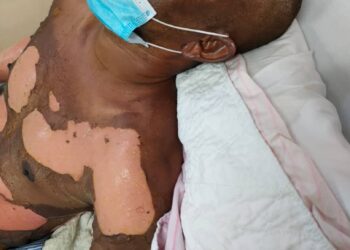 KEADAAN Mahari Md. Noor yang melecur pada seluruh badan akibat tong gas di rumahnya di Teluk Kumbar, Pulau Pinang yang meletup minggu lalu.