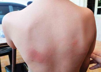 KESAN kecederaan yang didakwa akibat dipukul menggunakan pembaris besi pada bahagian belakang badan Abdul Fayyadh Rayyan Abdul Hisyam ketika ditemui di Kampung Guar Stesen di Yan. 
– MINGGUAN/OTHMAN YAHAYA