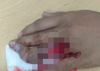 KEADAAN jari mangsa yang mengalami kecederaan patah jari dan kulit tersiat selepas cincin dipakainya tersangkut.