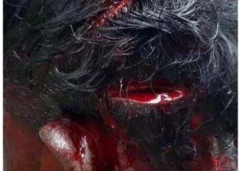 KEADAAN kepala mangsa yang ditetak dengan parang oleh rakan serumahnya kerana tidak berpuas hati ditegur untuk memperlahankan suara di Taman Nusa Bestari, Iskandar Puteri di Johor.