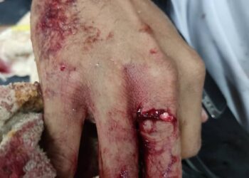 KECEDERAAN yang dialami di tangan kanan seorang anggota polis ketika bergelut dengan seorang tokan dadah di Kampung Baru Tepi Laut, Kuala Sanglang, Alor Setar semalam.