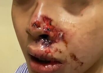 MANGSA yang dikatakan cedera selepas diserang anjing di Melaka.