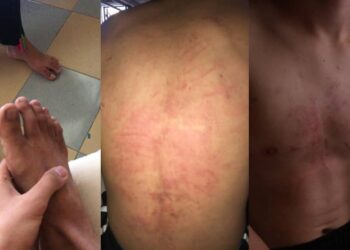 KESAN kecederaan di bahagian belakang badan, dada dan kaki yang dialami seorang pelajar sekolah teknik akibat dibuli senior.