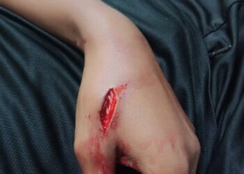 KECEDERAAN pada tangan salah seorang anggota polis akibat dilibas dengan parang dalam kejadian amuk di Kampung Sedar, Tumpat baru-baru ini.