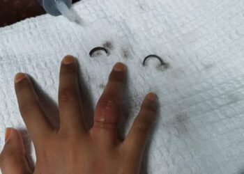 JARI manis tangan kanan Nuraisya Sofiea Sahdan mula membengkak manakala di sebelahnya sebentuk cincin besi yang berjaya ditanggalkan oleh anggota bomba di Balai Bomba Kuala Lipis di Lipis, Pahang. - FOTO/IHSAN BALAI BOMBA KUALA LIPIS
