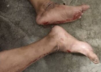 SEORANG lelaki terpaksa menahan kesakitan hampir setengah jam apabila kedua-dua belah pergelangan kakinya tersepit pada pintu lif dalam kejadian di Pangsapuri Desa Pinang 2, Jelutong, Pulau Pinang malam tadi.