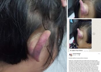 SEORANG kanak-kanak perempuan yang menghidap autisme mengalami lebam di bahagian telinga selepas didakwa menjadi mangsa dera seorang guru pendidikan khas di Seberang Jaya, Pulau Pinang baru-baru ini.
