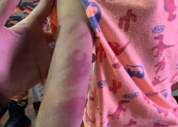 SALAH seorang mangsa dera dengan kesan lebam di tangan.